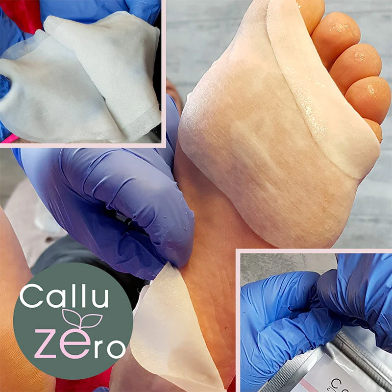 Detalle de parches y trabajo profesional sobre el pie en material de CalluZEro